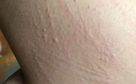 潍坊治疗荨麻疹好的专科医院