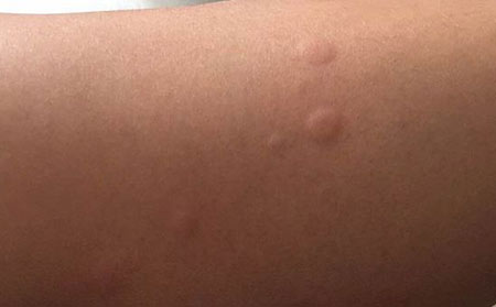 丘疹性荨麻疹的治疗原则