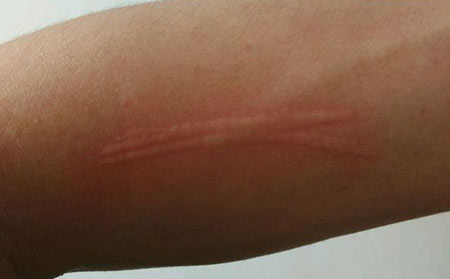 潍坊看荨麻疹比较好的医院_潍坊哪个荨麻疹的医院比较好