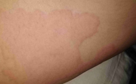 潍坊好的荨麻疹医院的判断标准是什么?