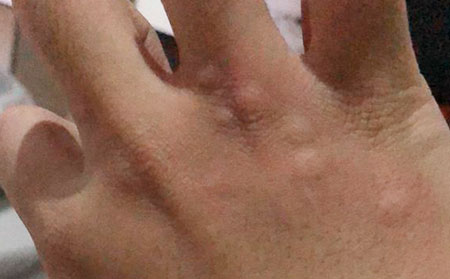 潍坊如何选择治疗荨麻疹的医院呢?