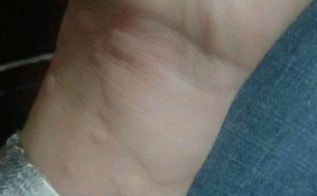 荨麻疹病症状是什么样的呢?