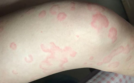 如何预防荨麻疹疾病的发生呢?