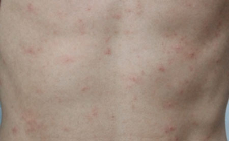 引起荨麻疹的原因都有哪些？