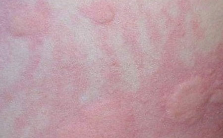 荨麻疹的病因都有哪些呢?