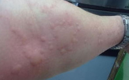 潍坊哪家医院治荨麻疹的比较好