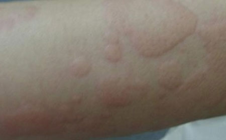 潍坊有什么好的荨麻疹医院