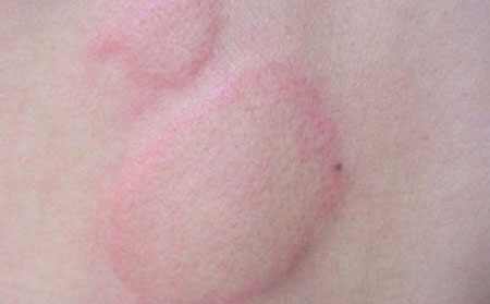 潍坊银康医院解析导致荨麻疹发生的原因?