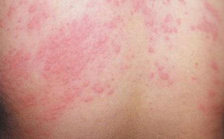 荨麻疹不治疗会不会好？