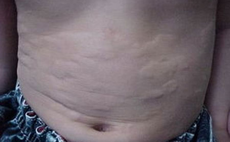 潍坊能看荨麻疹的医院