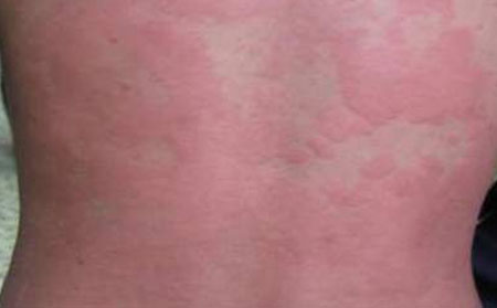 潍坊得了荨麻疹怎么治疗好