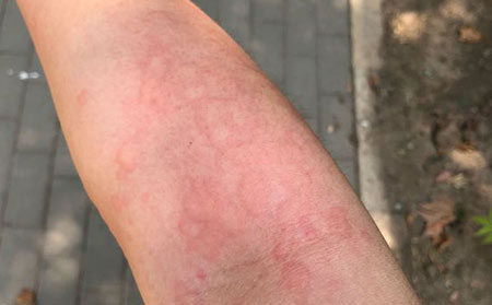 潍坊好的荨麻疹医院