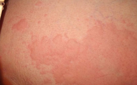 患上荨麻疹有哪些症状呢？